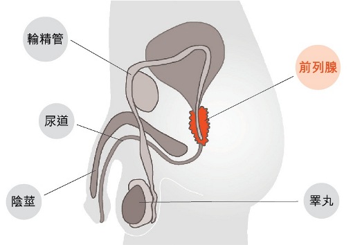 prostate cancer