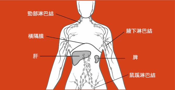 desktop_Non-Hodgkin_Lymphoma_Cancer_chi