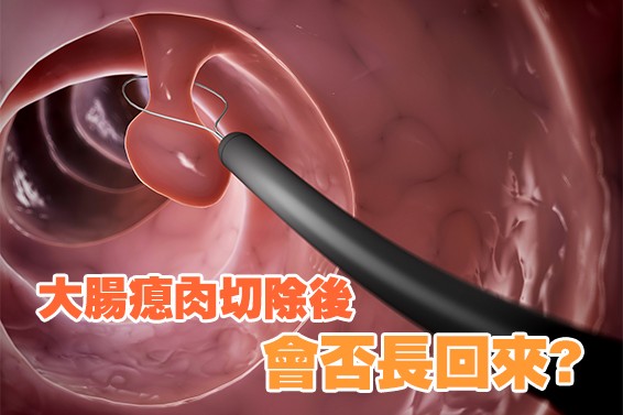 大腸瘜肉