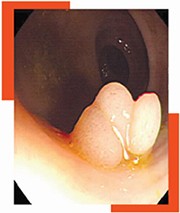 colorectal polyps